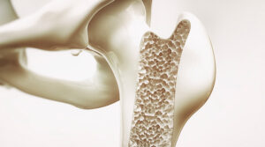 Blog - news 28 202002180124 osteoporosi big